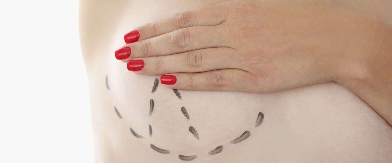 Mastektomia i metody rekonstrukcji piersi po amputacji