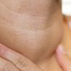 Wole tarczycy - rodzaje, objawy i leczenie
