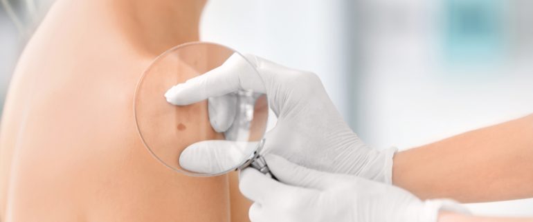 Nowotwory złośliwe skóry - rodzaje, objawy i leczenie