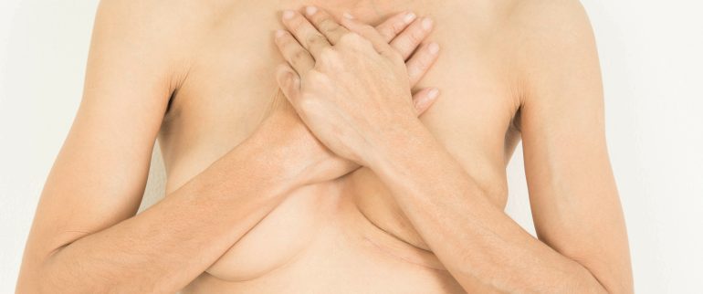 Mastektomia i jej rodzaje: oszczędna, radykalna, z jednoczesną rekonstrukcją