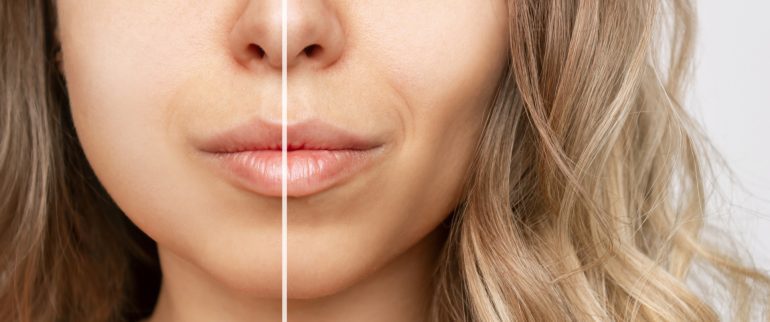 Usunięcie poduszek Bichata - sposób na wyszczuplenie twarzy