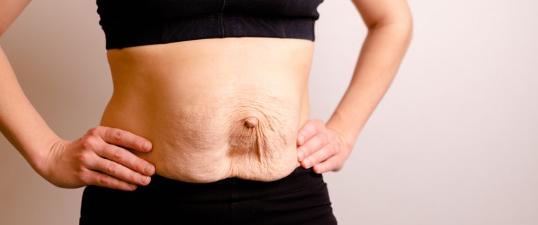 Przepuklina pępkowa po ciąży – jak wygląda i jak ją leczyć?