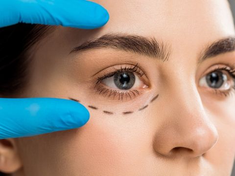 operacja-powiek-blefaroplastyka-korekta-krakow-scm