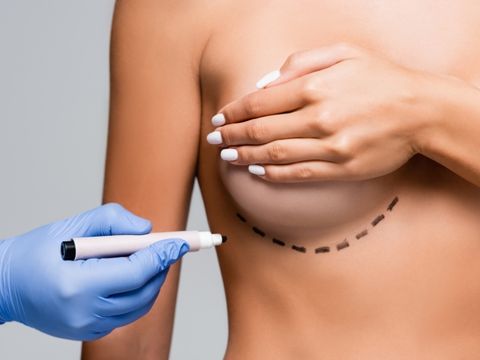 podniesienie-piersi-mastopeksja-krakow-scm