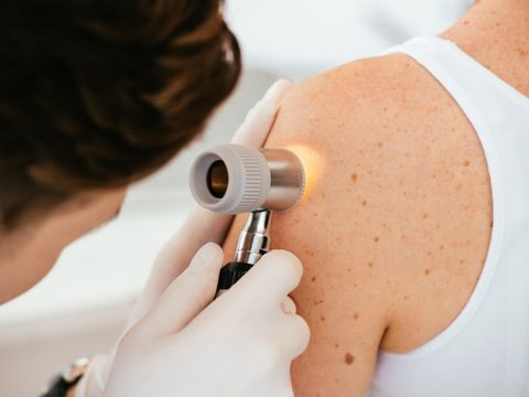 dermatoskopia-badanie-znamion-krakow-scm