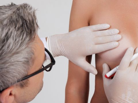 zapadnieta-brodawka-krakow-scm-clinic